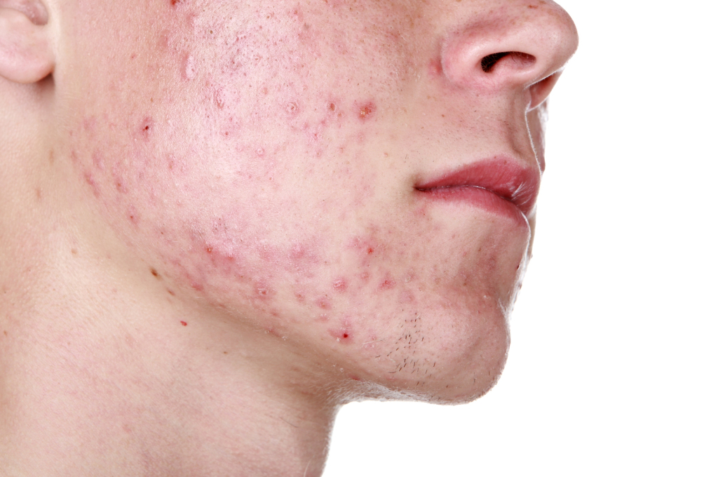 Acne Can be an Embarrassing Problem and Difficult to Treat