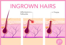 Most Ingrown Hairs straighten out within a week or two. If an ingrown hair persists or becomes infected, check with your doctor.