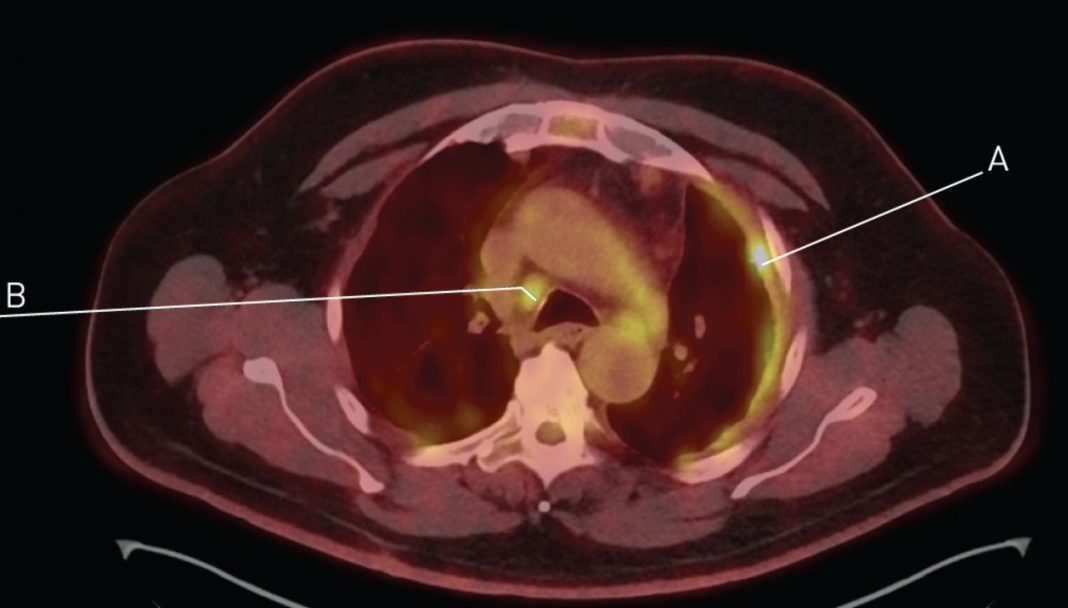 What is Malignant Pleural Mesothelioma? - Charismatic Planet