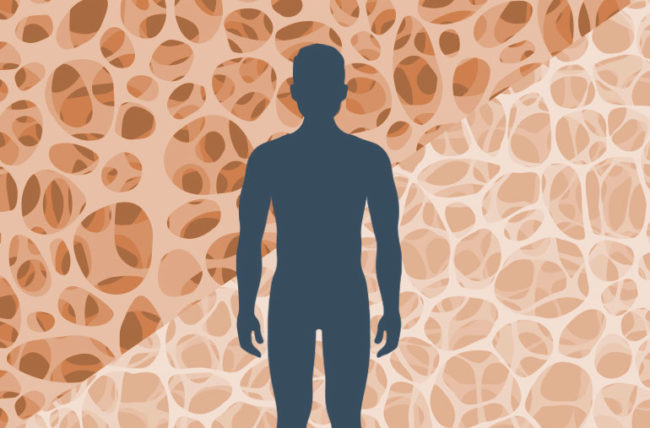 Osteoporosis is a common condition, affecting more than 24 million Americans, according to U.S. government figures.