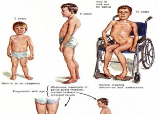 Muscular Dystrophy Symptoms and Treatment is very important to know. It is group of genetic conditions in which muscles become weak and wasted