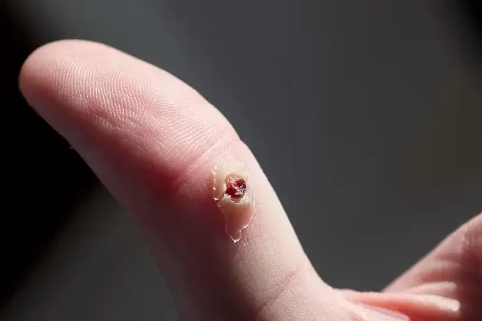 Warts are typically tough, flesh-colored little bumps on your skin caused by what’s known as the human papillomavirus.